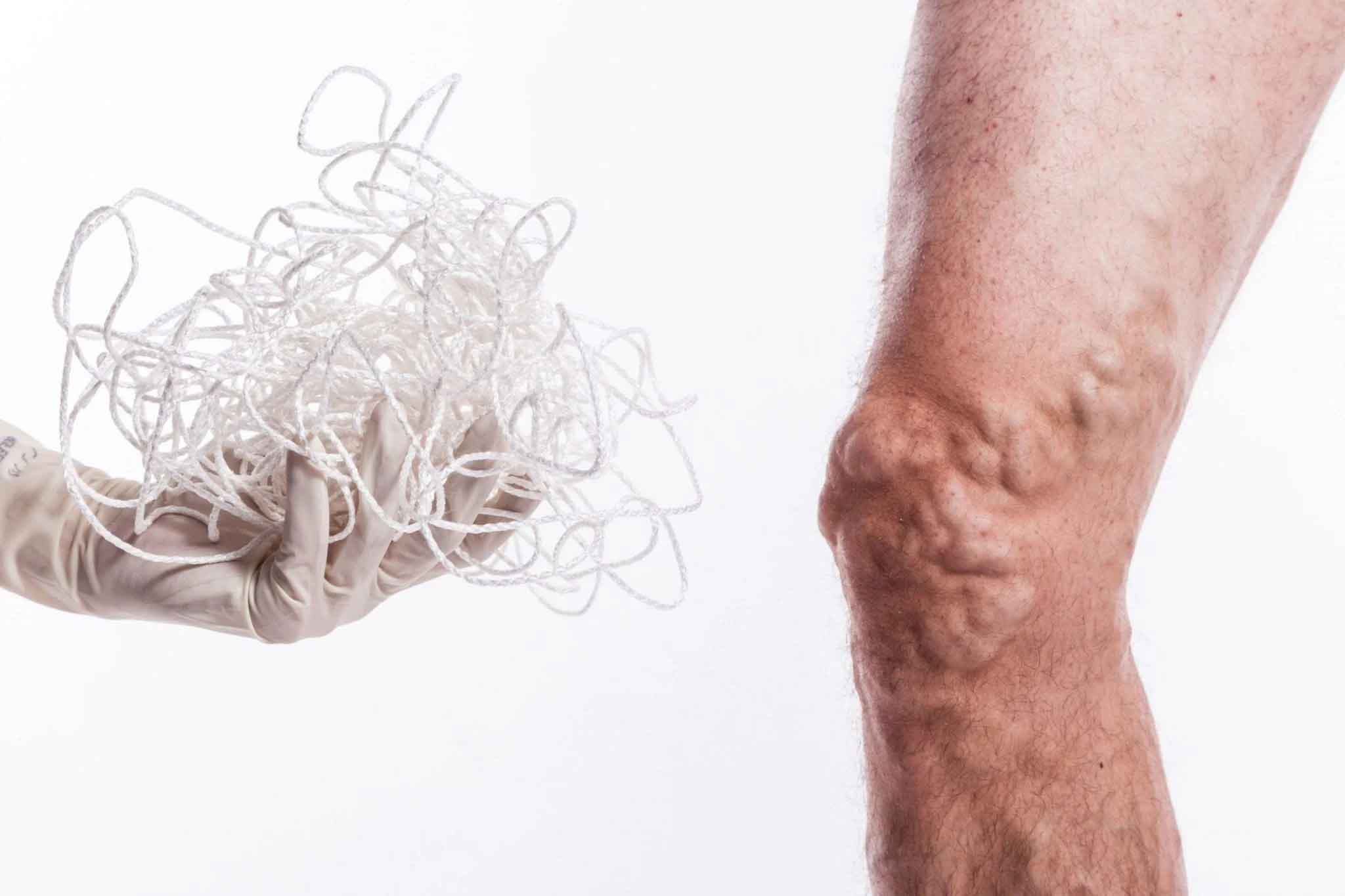 varicose vein