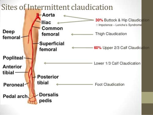 Claudication Rash What is Intermittent Claudication? What are its Symptoms, Causes, and ...