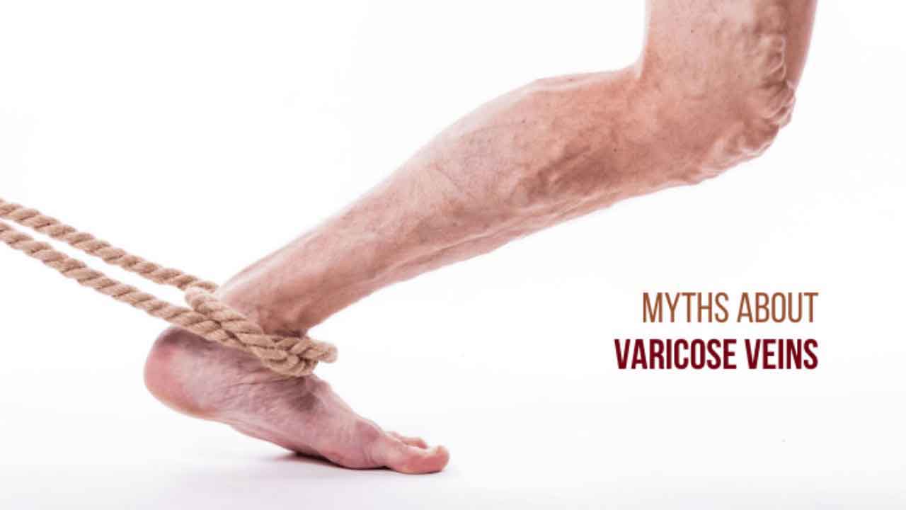 Myths about varicose vein